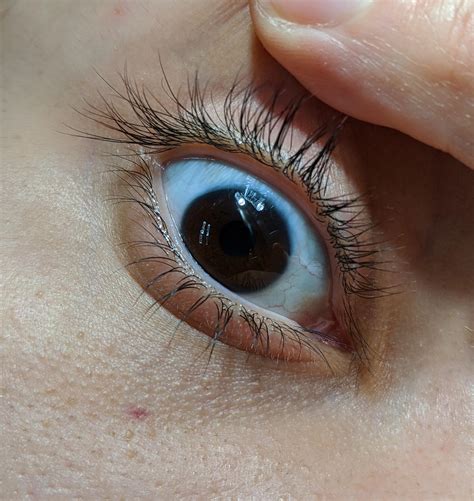 discovered   tetrastichiasis  rows  eyelashes