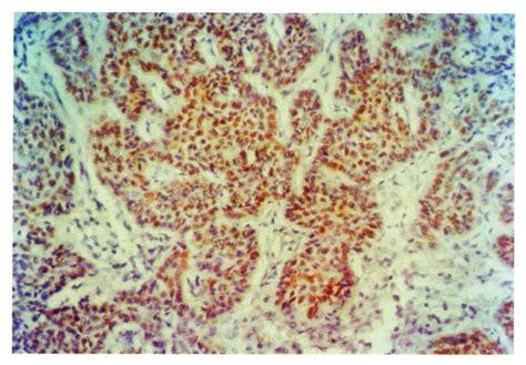 P53 Expression In Non Small Cell And Small Cell Lung Carcinomas