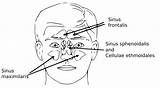 Sinus Sinusitis Sinuses Human Symptoms Infection Diagram Chronic Manage Treat Face Sphenoid Behind Eyes Nov sketch template