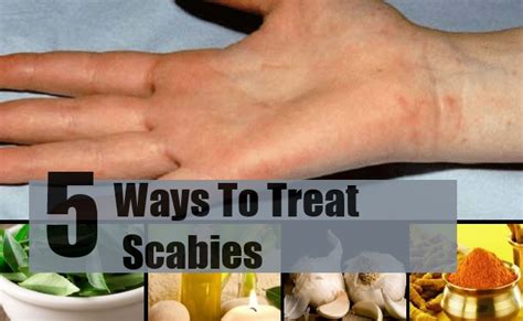 5 best and effective ways for scabies treatments find