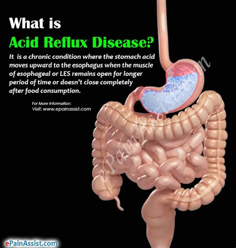 acid reflux diseasecausesrisk factorssymptomstreatment