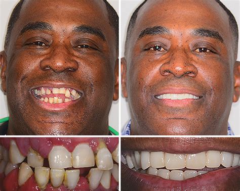 teeth implants     dental implant