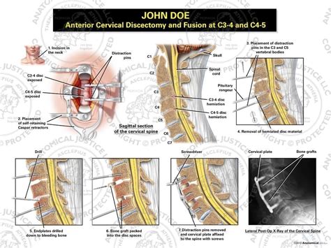Anterior Cervical Discectomy And Fusion At C3 4 And C4 5