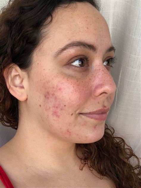 trying tretinoin week 1 complete step by step skin routine for