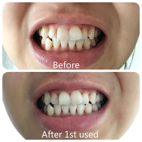 pop smile teeth whitening home kit review before and after