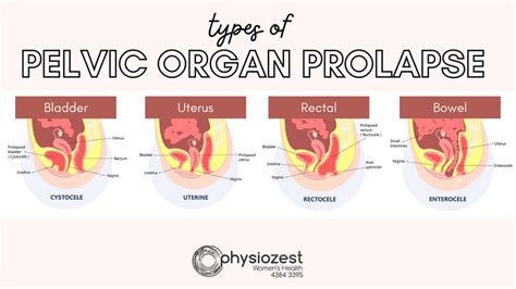 pelvic organ prolapse images