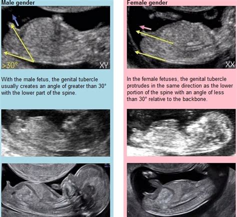 12 Week Ultrasound Pics Nub Theory Updated With The Sex