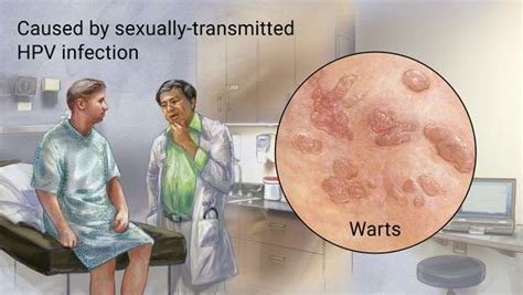 what are the symptoms of genital warts those who do not find time for taking care and making