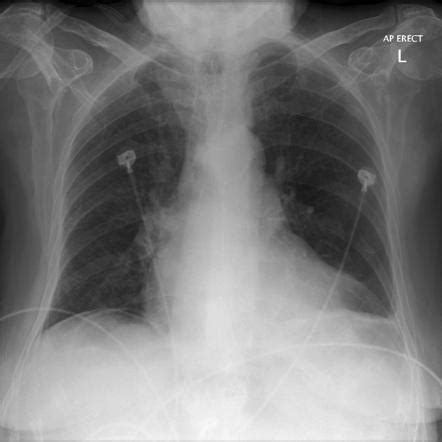 air  diaphragm cxr imaging case   week  emergucate