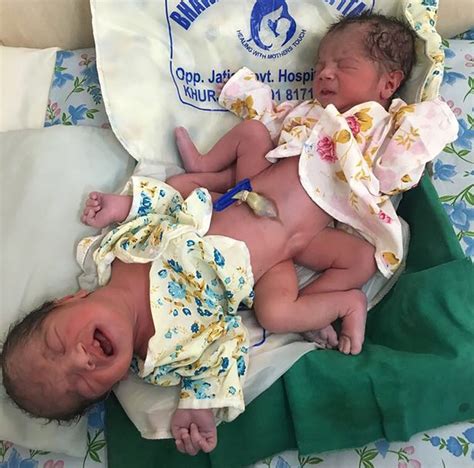 mum miraculously gives birth naturally to conjoined twins attached at
