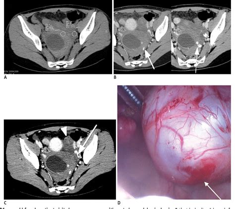 figure 3 from ruptured corpus luteal cyst prediction of clinical