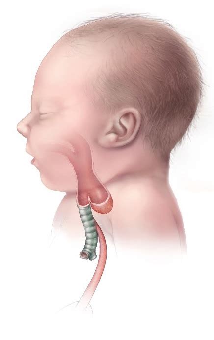 Esophageal Atresia And Tracheoesophageal Fistula Concise Medical