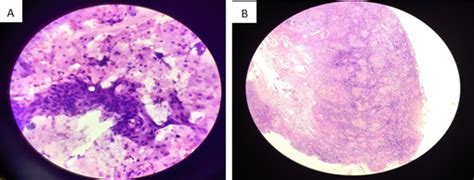 Clinical Radiological And Morphological Spectrum Of Squamous Cell