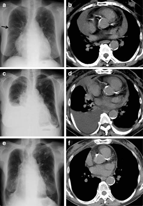 A Case Of Meigs Syndrome With Preceding Pericardial Effusion In