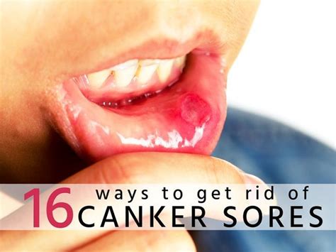 How To Get Rid Of Canker Sores Fast Cancer Sore Remedies