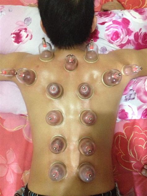 Cupping Therapy Ventosa Home Facebook