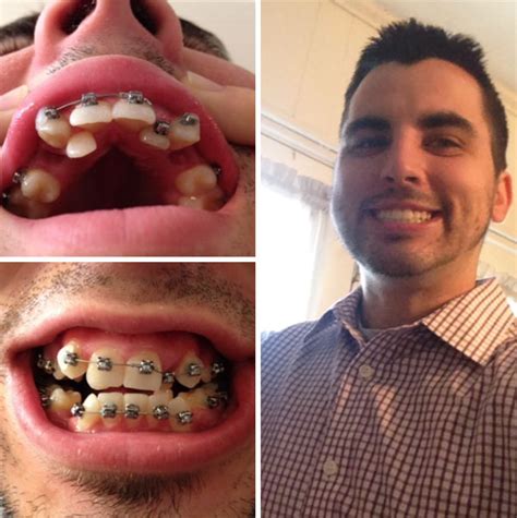 10 Incredible Before And After Transformations Of People Who Wore Braces