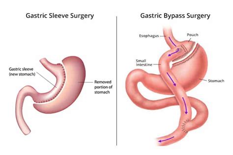Differentiating Gastric Sleeve Surgery And Gastric Bypass Surgery