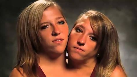 Amazing Meet The Conjoined Twins Who Have Been Living