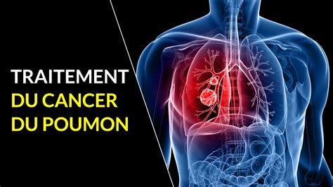 Immunothérapie Et Cancer Du Poumon Progrès En Immunothérapie Pour Le