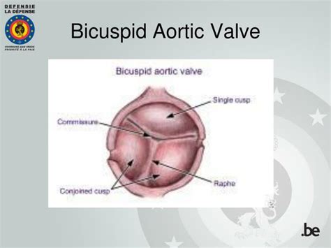 Ppt Aortic Bicuspid Valve In Flight Crew Case Reports And