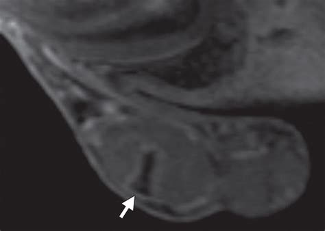 imaging of penile and scrotal emergencies radiographics