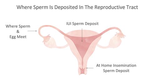 Insemination Approaches For Lesbian Women Fertilityiq