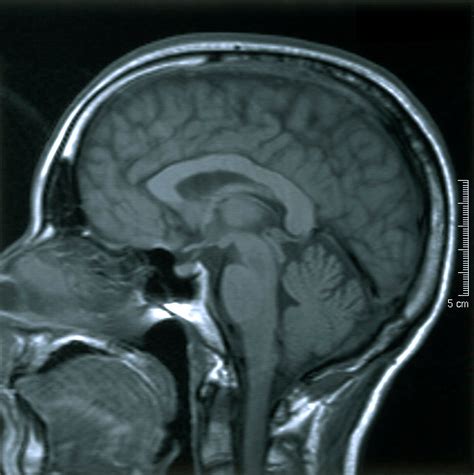 sagittal brain anatomy