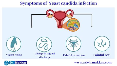 Yeast Candida Infection Homeopathic Treatment In Females