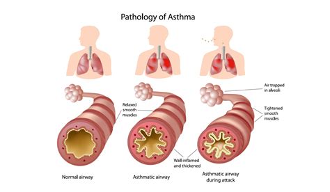 penyakit asma lelah tips kesihatan