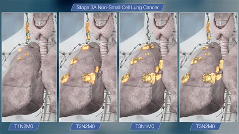 Small Cell Carcinoma Meaning Stage 2 Lung Cancer Cancer