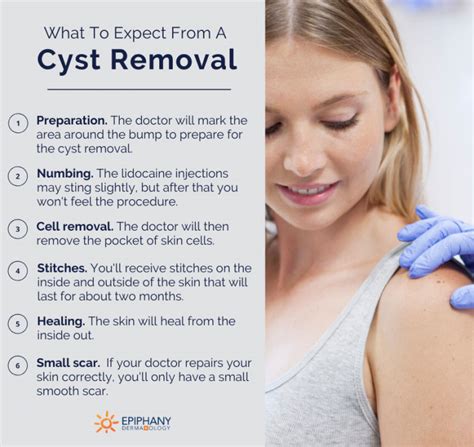 what to expect from a cyst removal the best cyst removal treatment