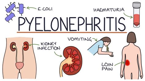 understanding pyelonephritis kidney infections youtube