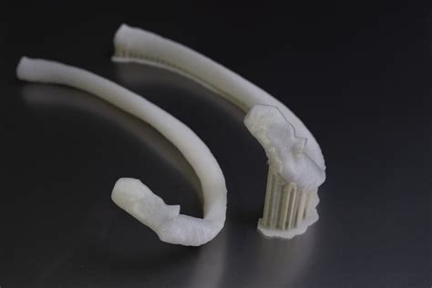 Patient Successfully Receives First Ever 3d Printed Rib Implant