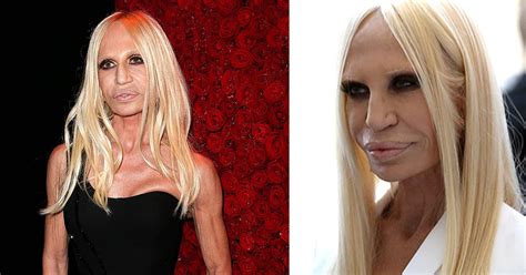 Have You Ever Seen Donatella Versace Before Her Plastic Surgeries She
