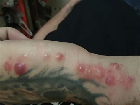 bed bug bite symptoms metro vancouver pest control service customer