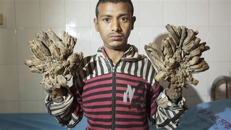 Man With Rare Skin Disease Has Tree Roots Growing From His Hands
