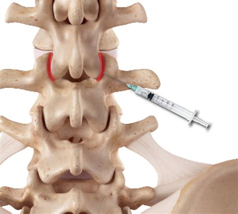 facet syndrome lumbar cervical arthrosis joint pain neck arthritis spondylolisthesis