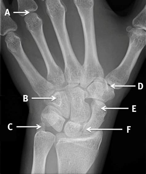 scaphoid view radiograph   left wrist  bmj