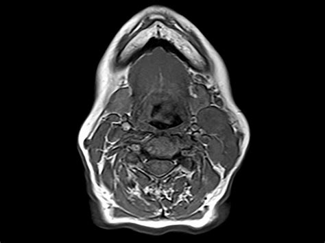 hpv associated neoplasms and other lesions in human