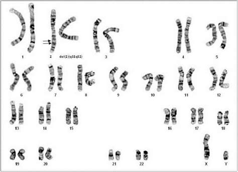 A Karyotype Of 46 Xy Del 2 Q31q32 The Arrows On The Normal