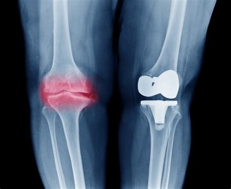 Total Knee Replacement Knee Surgery Oa Knee