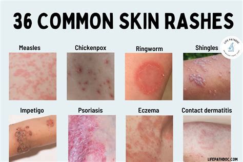 rash  common skin rashes pictures  treatment
