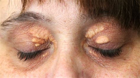 eyelid bumps     rid   med healthnet