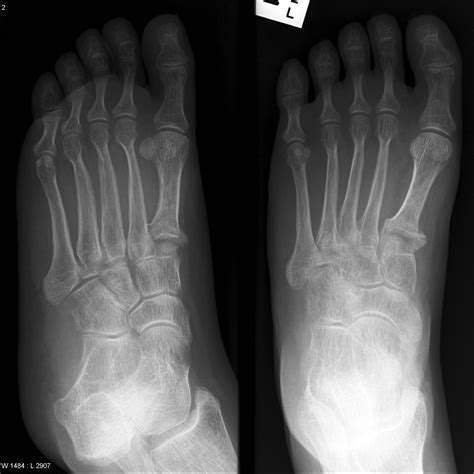 Osteogenesis Imperfecta With A Fracture Image