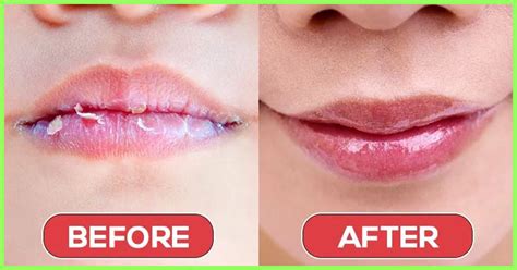 dry  chapped lips     annoying  worry   proper care  needed