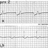 Bradycardia Rhythm Sinus Junctional Marked Patient sketch template