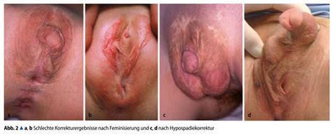 hermaphrodites genitals image 4 fap