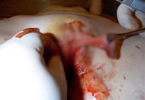 【閲覧注意】マ コのビラビラを切り取る「小陰唇縮小手術」がヤバい ポッカキット