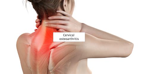 cervical arthritis neck arthrosis  prognosis treatments